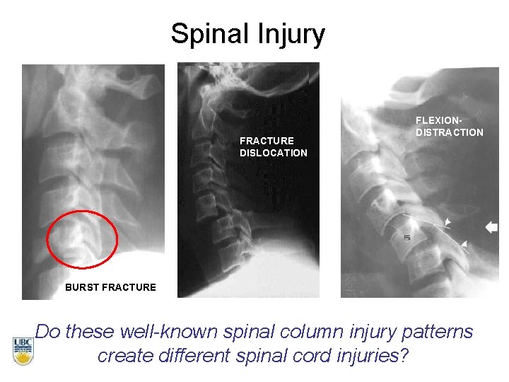 Spinal Injury FRACTURE DISLOCATION FLEXIONDISTRACTION BURST FRACTURE Do these well-known spinal column injury patterns