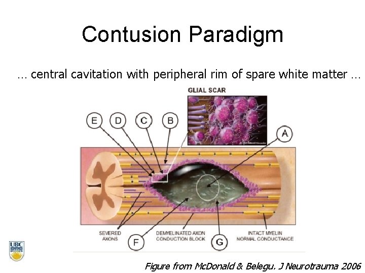 Contusion Paradigm … central cavitation with peripheral rim of spare white matter … Figure