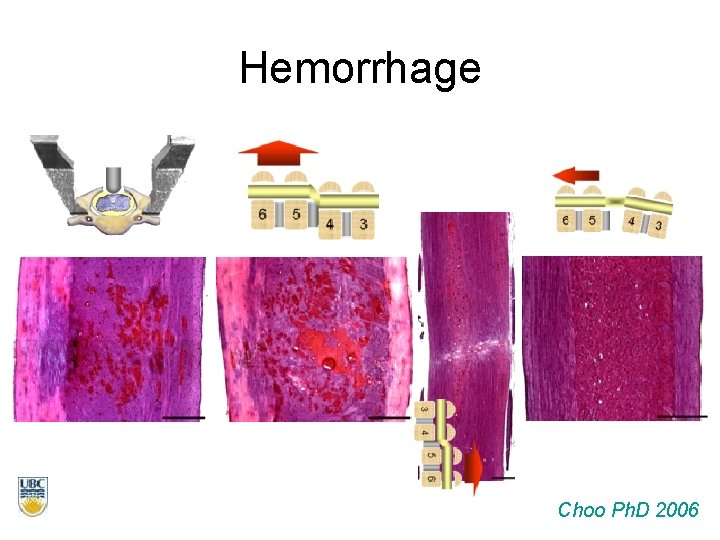 Hemorrhage Choo Ph. D 2006 