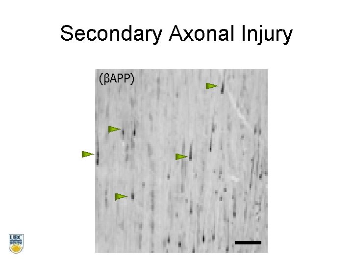 Secondary Axonal Injury (βAPP) 