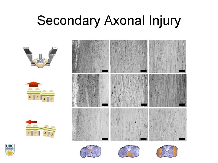 Secondary Axonal Injury 