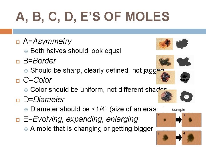 A, B, C, D, E’S OF MOLES A=Asymmetry B=Border Color should be uniform, not