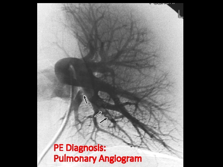 PE Diagnosis: Pulmonary Angiogram 