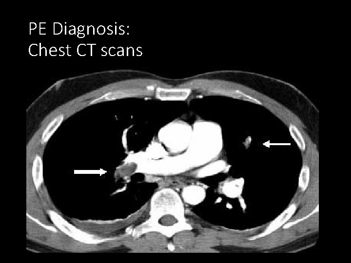 PE Diagnosis: Chest CT scans 