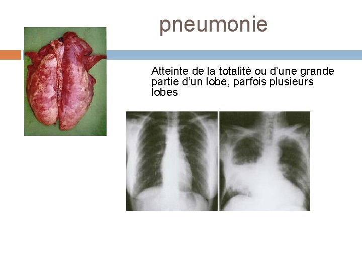 pneumonie Atteinte de la totalité ou d’une grande partie d’un lobe, parfois plusieurs lobes