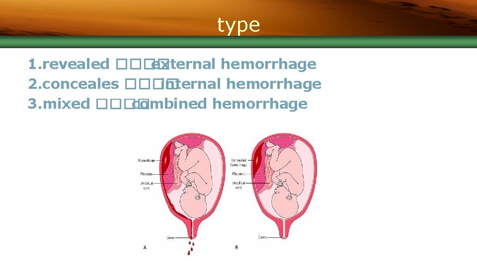 type 1. revealed ���� external hemorrhage 2. conceales ���� internal hemorrhage 3. mixed ����