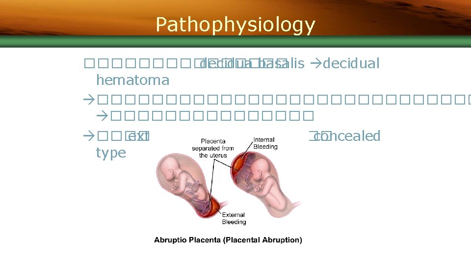 Pathophysiology �������� decidua basalis decidual hematoma �������������� ���� external hemorrhage ���� concealed type 