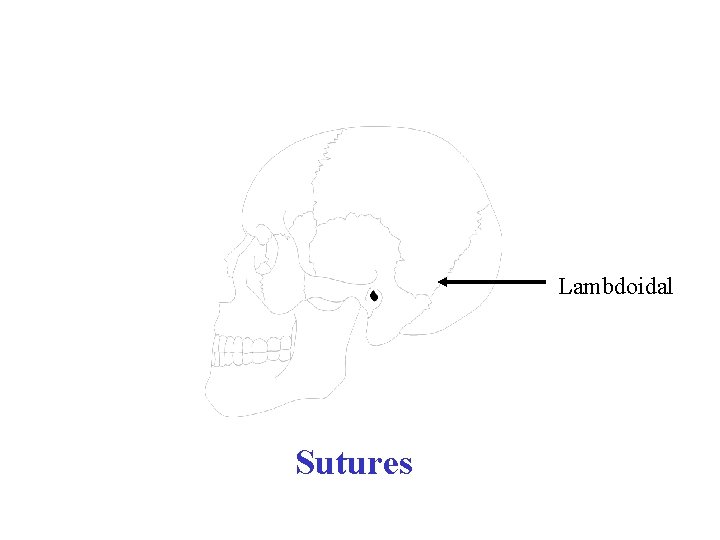 Lambdoidal Sutures 