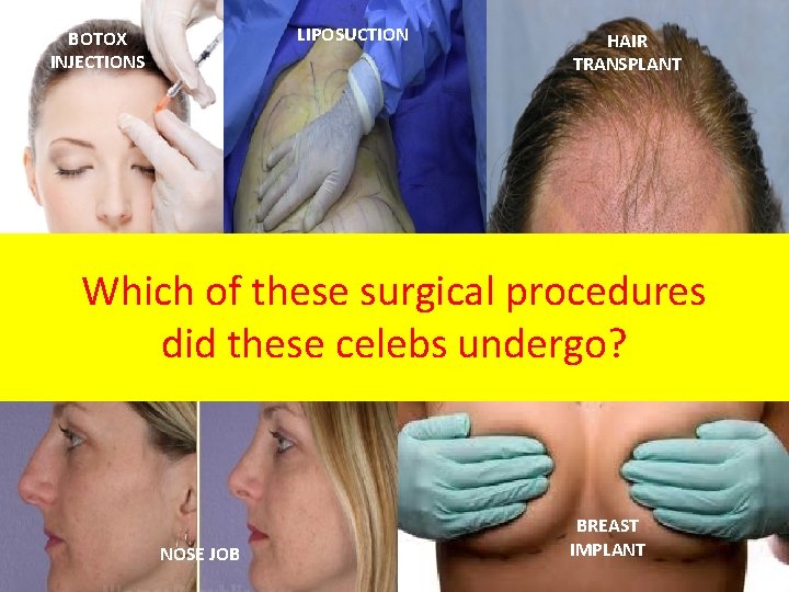 LIPOSUCTION BOTOX INJECTIONS HAIR TRANSPLANT Which of these surgical procedures did these celebs undergo?