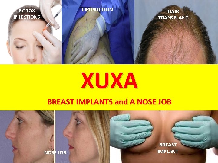 LIPOSUCTION BOTOX INJECTIONS HAIR TRANSPLANT XUXA BREAST IMPLANTS and A NOSE JOB BREAST IMPLANT