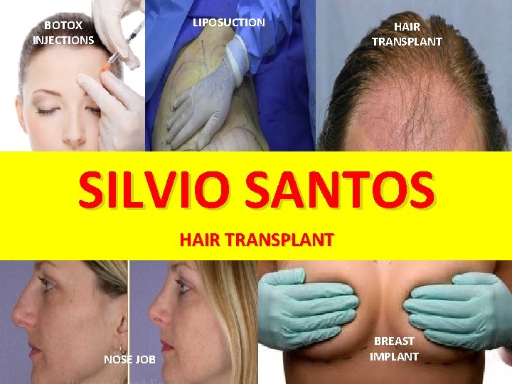 LIPOSUCTION BOTOX INJECTIONS HAIR TRANSPLANT SILVIO SANTOS HAIR TRANSPLANT NOSE JOB BREAST IMPLANT 