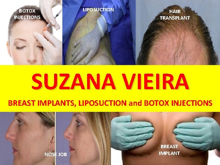 LIPOSUCTION BOTOX INJECTIONS HAIR TRANSPLANT SUZANA VIEIRA BREAST IMPLANTS, LIPOSUCTION and BOTOX INJECTIONS NOSE