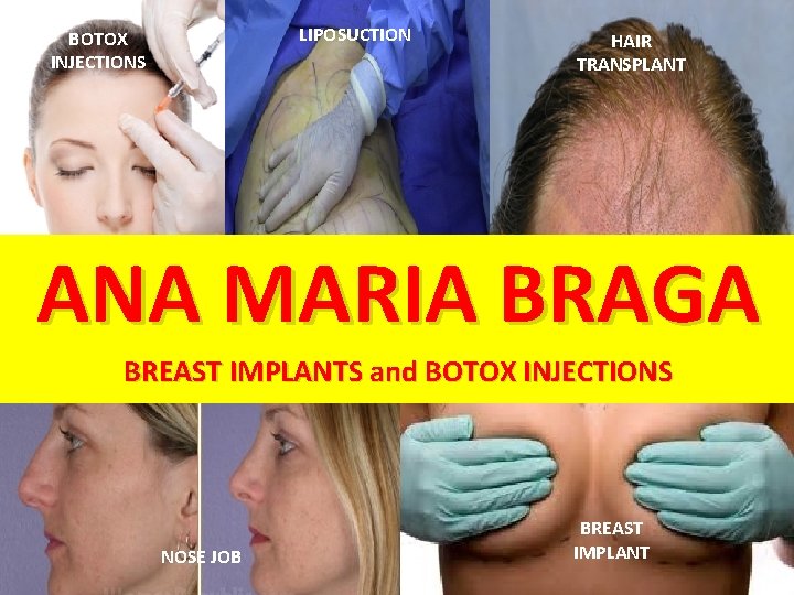 LIPOSUCTION BOTOX INJECTIONS HAIR TRANSPLANT ANA MARIA BRAGA BREAST IMPLANTS and BOTOX INJECTIONS NOSE
