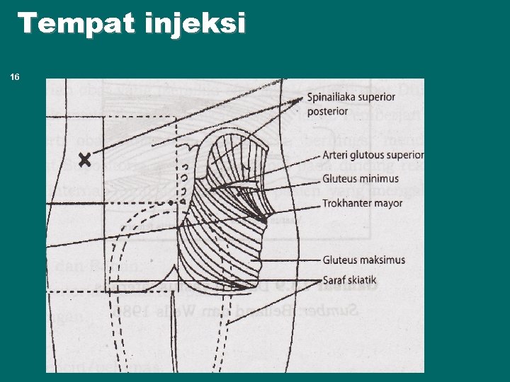 Tempat injeksi 16 