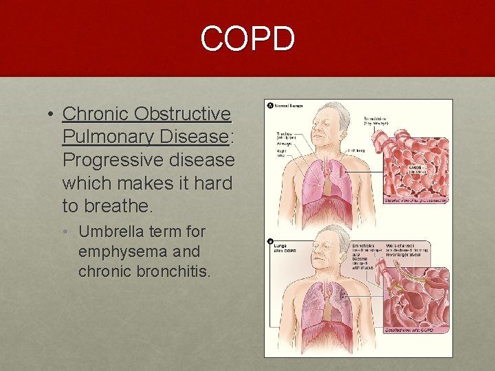 COPD • Chronic Obstructive Pulmonary Disease: Progressive disease which makes it hard to breathe.