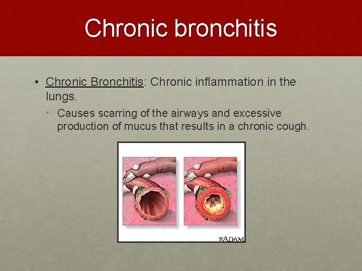 Chronic bronchitis • Chronic Bronchitis: Chronic inflammation in the lungs. • Causes scarring of