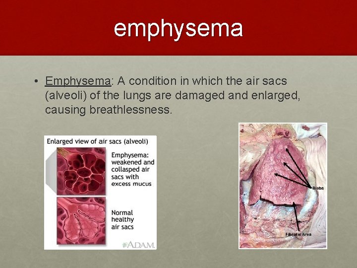 emphysema • Emphysema: A condition in which the air sacs (alveoli) of the lungs