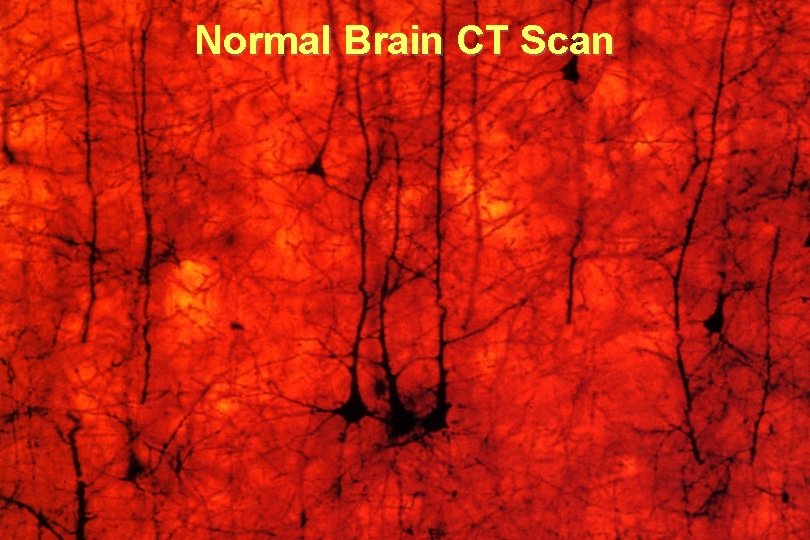 Normal Brain CT Scan 