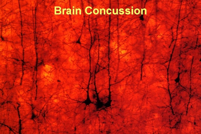 Brain Concussion 