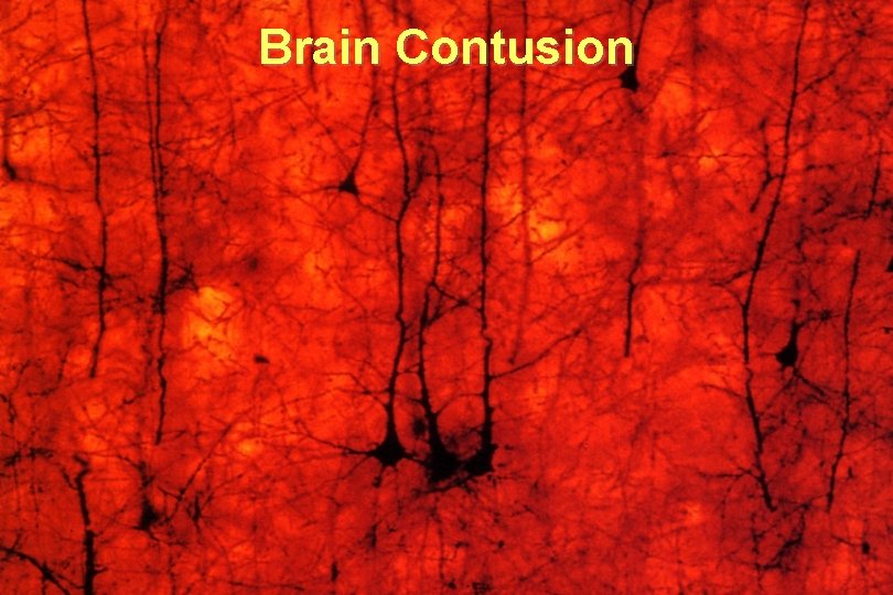 Brain Contusion 
