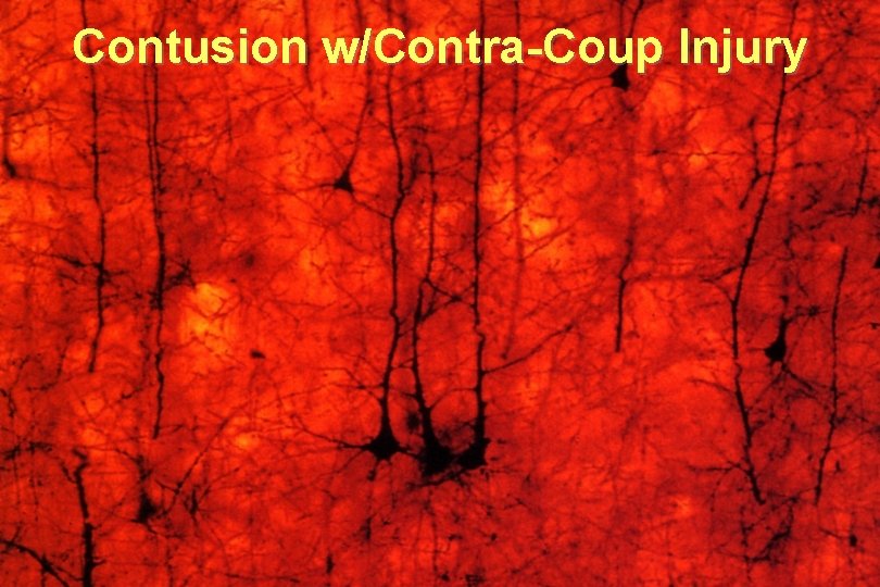 Contusion w/Contra-Coup Injury 