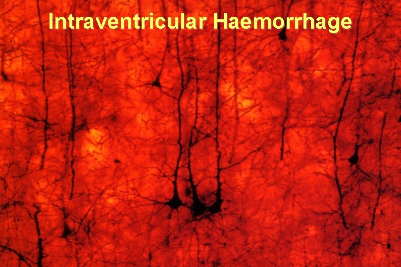 Intraventricular Haemorrhage 