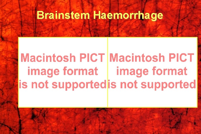 Brainstem Haemorrhage 