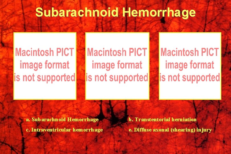 Subarachnoid Hemorrhage a. Subarachnoid Hemorrhage b. Transtentorial herniation c. Intraventricular hemorrhage e. Diffuse axonal