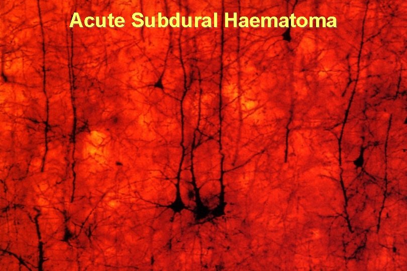 Acute Subdural Haematoma 