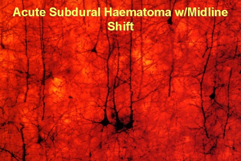 Acute Subdural Haematoma w/Midline Shift 