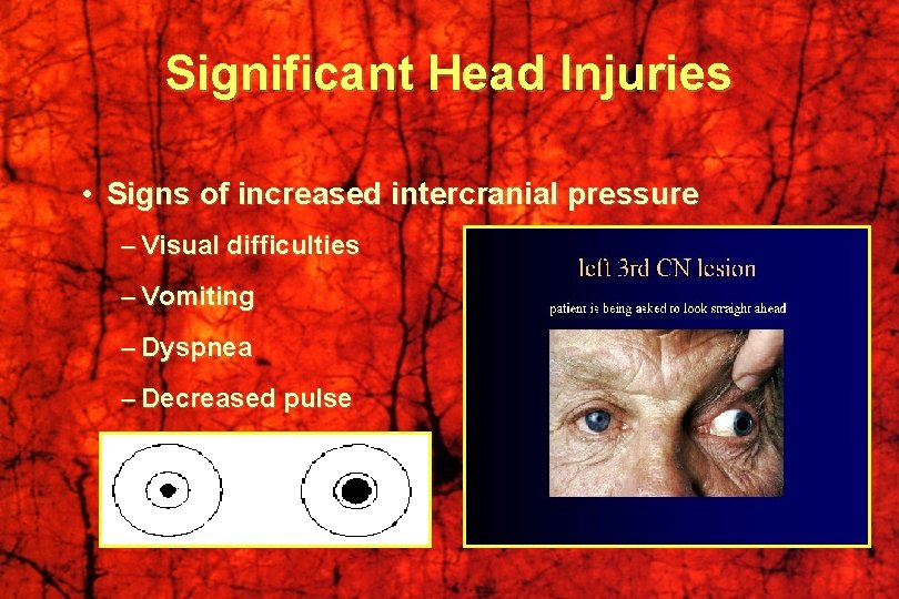 Significant Head Injuries • Signs of increased intercranial pressure – Visual difficulties – Vomiting