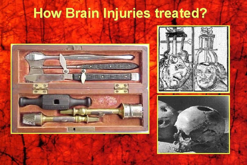 How Brain Injuries treated? 