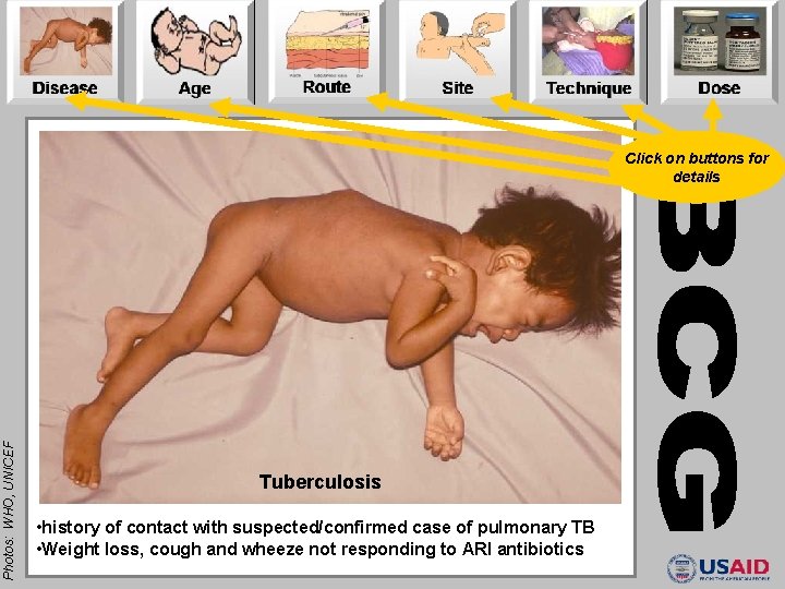 Photos: WHO, UNICEF Click on buttons for details Tuberculosis • history of contact with