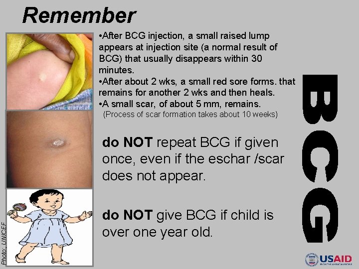 Remember • After BCG injection, a small raised lump appears at injection site (a