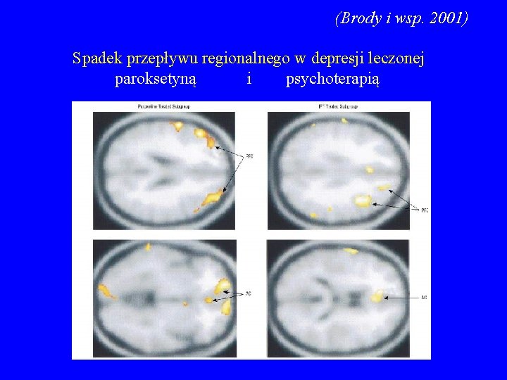 (Brody i wsp. 2001) Spadek przepływu regionalnego w depresji leczonej paroksetyną i psychoterapią 