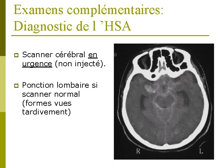 Examens complémentaires: Diagnostic de l ’HSA p Scanner cérébral en urgence (non injecté). p