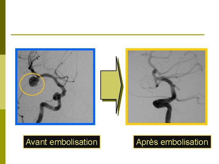 Avant embolisation Après embolisation 