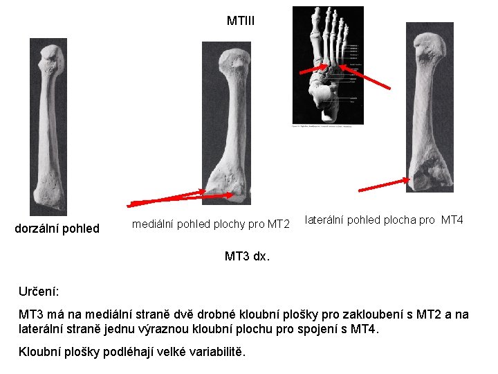 MTIII dorzální pohled mediální pohled plochy pro MT 2 laterální pohled plocha pro MT