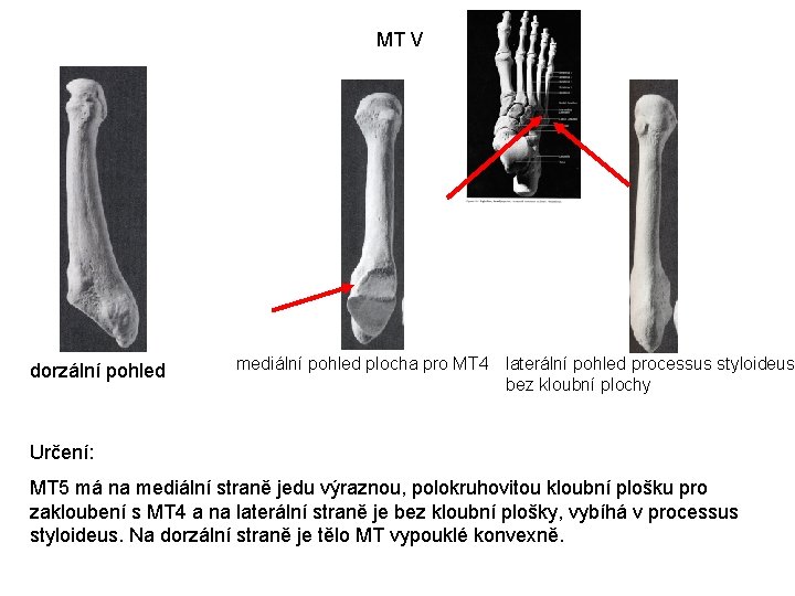 MT V dorzální pohled mediální pohled plocha pro MT 4 laterální pohled processus styloideus