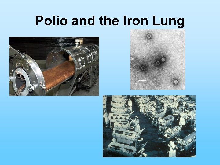 Polio and the Iron Lung 