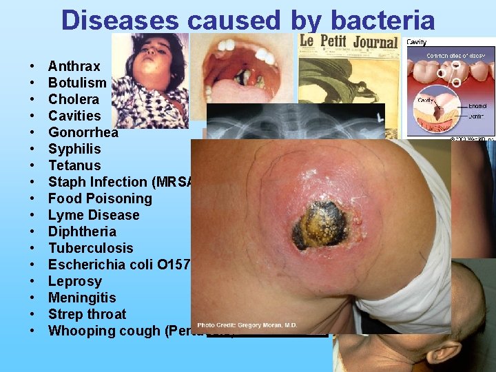 Diseases caused by bacteria • • • • • Anthrax Botulism Cholera Cavities Gonorrhea