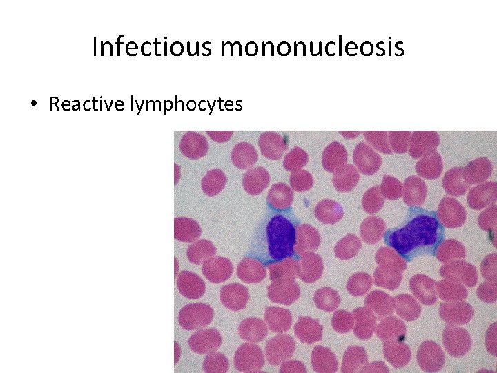 Infectious mononucleosis • Reactive lymphocytes 