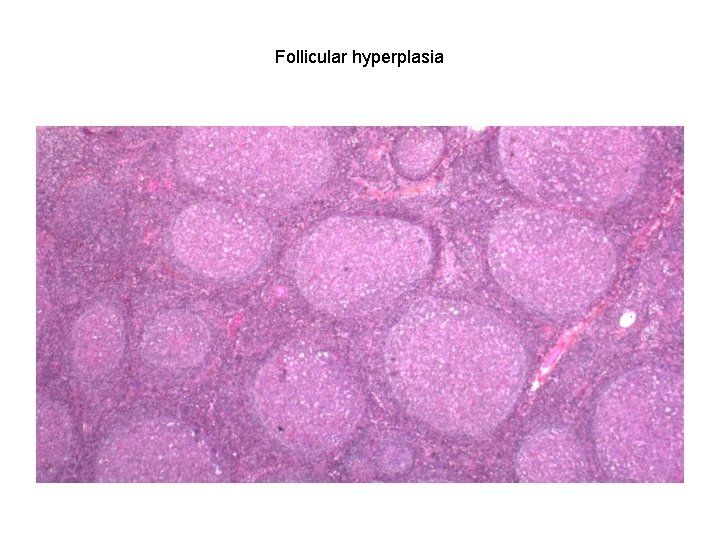Follicular hyperplasia 