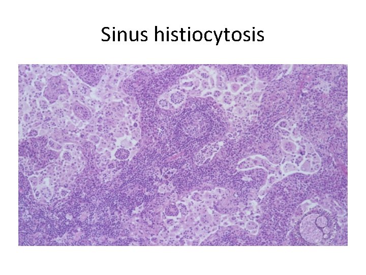 Sinus histiocytosis 