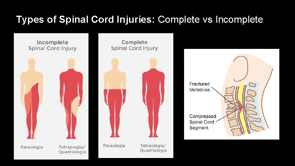 Types of Spinal Cord Injuries: Complete vs Incomplete 