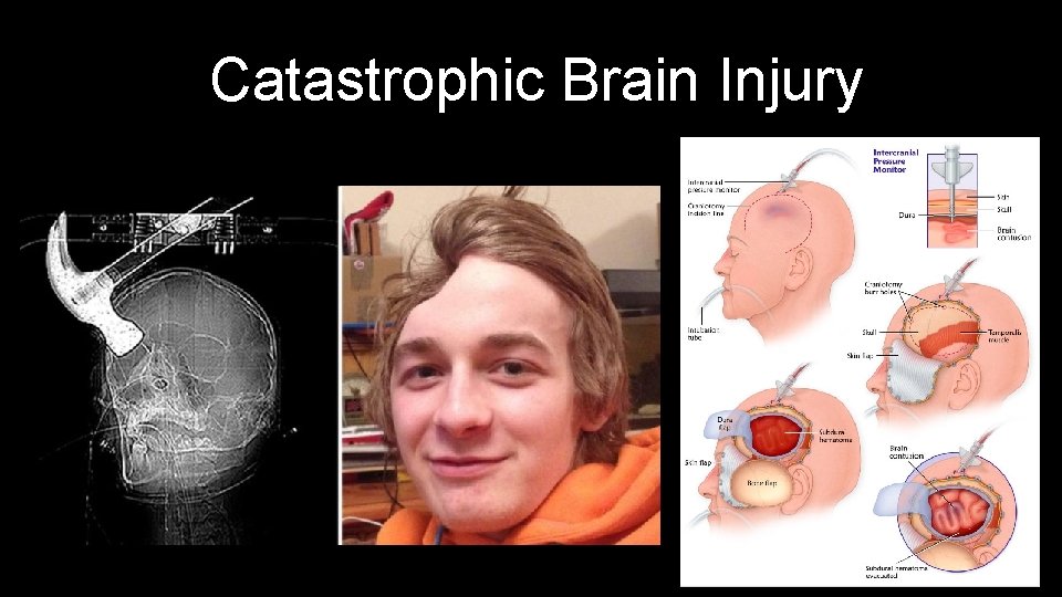 Catastrophic Brain Injury 