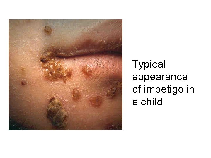 Typical appearance of impetigo in a child 