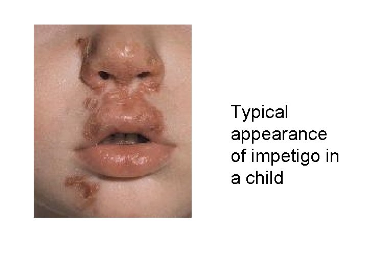Typical appearance of impetigo in a child 