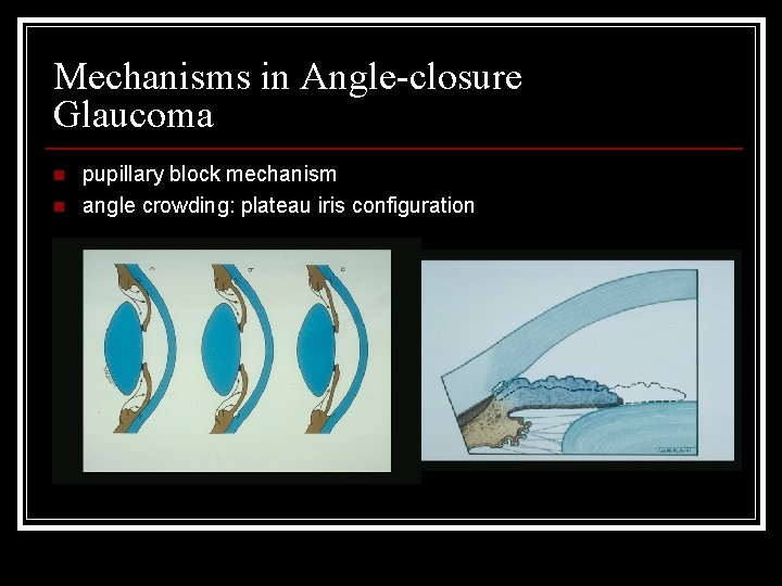 Mechanisms in Angle-closure Glaucoma n n pupillary block mechanism angle crowding: plateau iris configuration