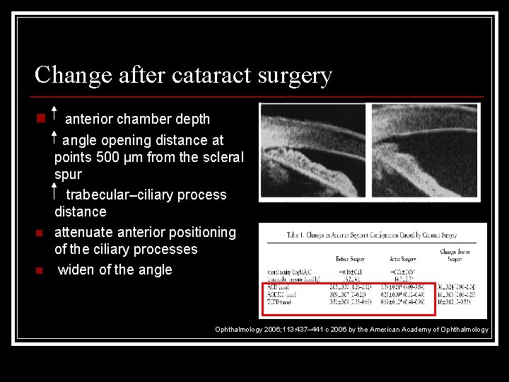 Change after cataract surgery n n n anterior chamber depth angle opening distance at